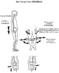 Varus. Globale Haltungsreprogrammation